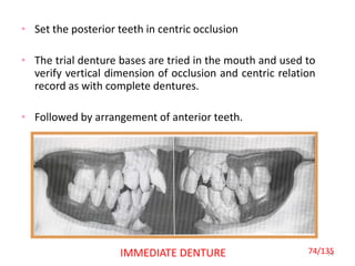 • Set the posterior teeth in centric occlusion
• The trial denture bases are tried in the mouth and used to
verify vertical dimension of occlusion and centric relation
record as with complete dentures.
• Followed by arrangement of anterior teeth.
74IMMEDIATE DENTURE 74/135
 