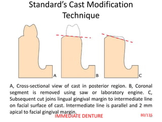 Standard’s Cast Modification
Technique
80
A, Cross-sectional view of cast in posterior region. B, Coronal
segment is removed using saw or laboratory engine. C,
Subsequent cut joins lingual gingival margin to intermediate line
on facial surface of cast. Intermediate line is parallel and 2 mm
apical to facial gingival margin.
80/135IMMEDIATE DENTURE
 