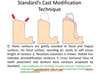 Standard’s Cast Modification
Technique
D, Stone contours are gently rounded at facial and lingual
surfaces. On facial surface, rounding ex- tends to soft tissue
height of contour. E, Resultant reduction is shown. Dotted line
indicates premodification contours. F, Cross Sectional View of
tooth placement and denture base contours proposed by
Standard. - Cast modification for immediate complete dentures: Traditional and
contemporary considerations with an spatial modeling (J Prosthet Dent
2008;100:399-405)
81/135IMMEDIATE DENTURE
 