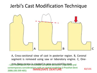 Jerbi’s Cast Modification Technique
A, Cross-sectional view of cast in posterior region. B, Coronal
segment is removed using saw or laboratory engine. C, One-
mm-deep recess is created in area occupied by root.- Cast modification for immediate complete dentures: Traditional and
contemporary considerations with an spatial modeling (J Prosthet Dent
2008;100:399-405)
82/135IMMEDIATE DENTURE
 