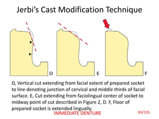 Jerbi’s Cast Modification Technique
D, Vertical cut extending from facial extent of prepared socket
to line denoting junction of cervical and middle thirds of facial
surface. E, Cut extending from faciolingual center of socket to
midway point of cut described in Figure 2, D. F, Floor of
prepared socket is extended lingually.
83/135IMMEDIATE DENTURE
 