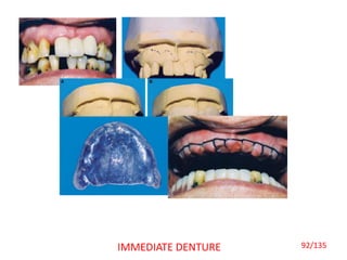 92/135IMMEDIATE DENTURE
 