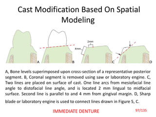 Cast Modification Based On Spatial
Modeling
A, Bone levels superimposed upon cross-section of a representative posterior
segment. B, Coronal segment is removed using saw or laboratory engine. C,
Two lines are placed on surface of cast. One line arcs from mesiofacial line
angle to distofacial line angle, and is located 2 mm lingual to midfacial
surface. Second line is parallel to and 4 mm from gingival margin. D, Sharp
blade or laboratory engine is used to connect lines drawn in Figure 5, C.
97/135IMMEDIATE DENTURE
 