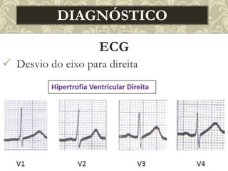 ECG
 Desvio do eixo para direita
DIAGNÓSTICO
 