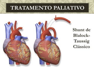 Shunt de
Blalock-
Taussig
Clássico
TRATAMENTO PALIATIVO
 