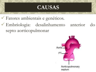  Fatores ambientais e genéticos.
 Embriologia: desalinhamento anterior do
septo aorticopulmonar
CAUSAS
 