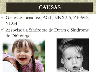  Genes associados: JAG1, NKX2-5, ZFPM2,
VEGF
 Associada a Síndrome de Down e Síndrome
de DiGeorge.
CAUSAS
 
