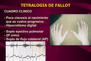 TETRALOGIA DE FALLOT CUADRO CLINICO - Poca cianosis al nacimiento que se vuelve progresiva - Hipocratismo digital - Soplo eyectivo pulmonar - 2P único - Soplo de flujo colateral (AP) 