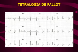 TETRALOGIA DE FALLOT 