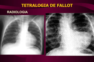TETRALOGIA DE FALLOT RADIOLOGIA 