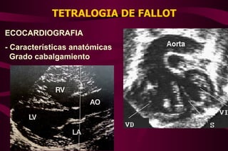 TETRALOGIA DE FALLOT ECOCARDIOGRAFIA - Características anatómicas Grado cabalgamiento 