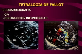 TETRALOGIA DE FALLOT ECOCARDIOGRAFIA - CIV  - OBSTRUCCION INFUNDIBULAR 