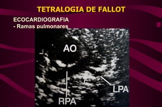 TETRALOGIA DE FALLOT ECOCARDIOGRAFIA - Ramas pulmonares 