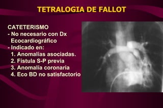 TETRALOGIA DE FALLOT CATETERISMO - No necesario con Dx  Ecocardiográfico - Indicado en: 1. Anomalías asociadas. 2. Fístula S-P previa 3. Anomalía coronaria 4. Eco BD no satisfactorio 