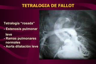 TETRALOGIA DE FALLOT Tetralogía “rosada” - Estenosis pulmonar  leve - Ramas pulmonares  normales - Aorta dilatación leve 