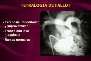 TETRALOGIA DE FALLOT - Estenosis infundíbular y supravalvular - Tronco con leve hipoplasia - Ramas normales 