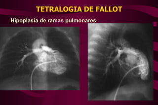 TETRALOGIA DE FALLOT Hipoplasia de ramas pulmonares 