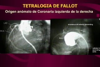 TETRALOGIA DE FALLOT Origen anómalo de Coronaria izquierda de la derecha 
