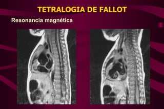 TETRALOGIA DE FALLOT Resonancia magnética 
