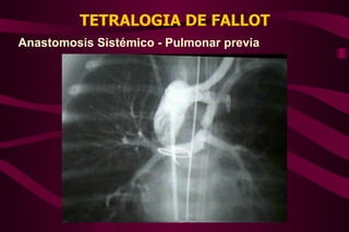 TETRALOGIA DE FALLOT Anastomosis Sistémico - Pulmonar previa 