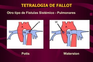 TETRALOGIA DE FALLOT Otro tipo de Fístulas Sistémico - Pulmonares Waterston Potts 