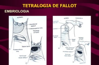 TETRALOGIA DE FALLOT EMBRIOLOGIA 