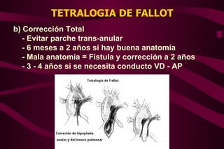 TETRALOGIA DE FALLOT b) Corrección Total - Evitar parche trans-anular - 6 meses a 2 años si hay buena anatomía - Mala anatomía = Fístula y corrección a 2 años - 3 - 4 años si se necesita conducto VD - AP 