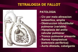 TETRALOGIA DE FALLOT PATOLOGIA - Civ por mala alineacion subaortica, amplia - Obstruccion infundibular pulmonar (variable) - Hipoplasia del anillo valvular pulmonar - Tronco pulmonar presente - Ramas hipoplasicas  (estenosis periferica) - Aorta dilatada, cabalgante 
