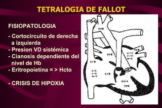 TETRALOGIA DE FALLOT FISIOPATOLOGIA - Cortocircuito de derecha  a izquierda - Presion VD sistémica - Cianosis dependiente del nivel de Hb - Eritropoietina = > Hcto - CRISIS DE HIPOXIA 