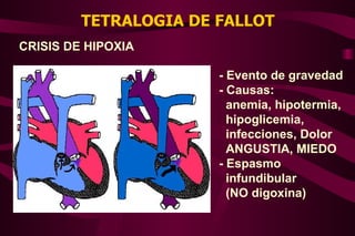TETRALOGIA DE FALLOT CRISIS DE HIPOXIA - Evento de gravedad - Causas: anemia, hipotermia, hipoglicemia,  infecciones, Dolor ANGUSTIA, MIEDO - Espasmo  infundibular  (NO digoxina) 
