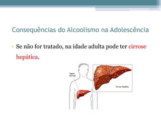 Consequências do Alcoolismo na Adolescência
• Se não for tratado, na idade adulta pode ter cirrose
hepática.
 