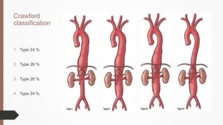 Crawford
classification
1. Type 24 %
2. Type 26 %
3. Type 26 %
4. Type 24 %
 