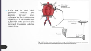  liberal use of multi head
perfusion cannulae and
pediatric coronary sinus
catheters for the maintenance
of perfusion to the visceral and
subclavian aortic branches and
dominant intercostal arteries,
respectively.
 