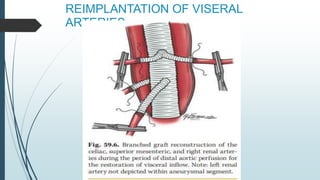 REIMPLANTATION OF VISERAL
ARTERIES
 