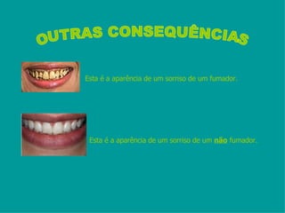 Esta é a aparência de um sorriso de um fumador. ´ Esta é a aparência de um sorriso de um  não  fumador. OUTRAS CONSEQUÊNCIAS 