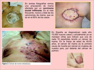 En ambas fotografías vemos una amputación de mama afectada por un  carcinoma ductal infiltrante.  Es el más frecuente, nocivo y letal de los carcinomas de mama, que se da en el 80% de los casos. En España se diagnostican cada año 15.000 nuevos casos   y actualmente ya se manejan cifras que indican que una de cada 18 españolas tendrá un cáncer de mama. En la franja de edad de 45-55 años, el cáncer de mama es la primera causa de muerte por cáncer en mujeres de nuestro país, por delante del cáncer de pulmón. 