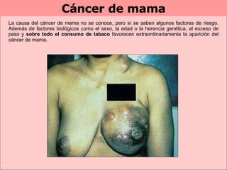 Cáncer de mama La causa del cáncer de mama no se conoce, pero sí se saben algunos factores de riesgo. Además de factores biológicos como el sexo, la edad o la herencia genética, el exceso de peso y  sobre todo   el consumo de tabaco  favorecen extraordinariamente la aparición del cáncer de mama. 