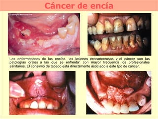 Cáncer de encía Las enfermedades de las encías, las lesiones precancerosas y el cáncer son las patologías orales a las que se enfrentan con mayor frecuencia los profesionales sanitarios. El consumo de tabaco está directamente asociado a éste tipo de cáncer.  