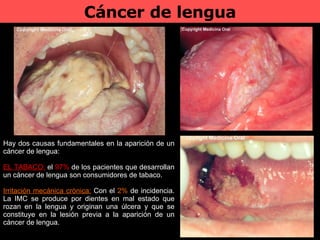Cáncer de lengua Hay dos causas fundamentales en la aparición de un cáncer de lengua: EL TABACO:  el  97%  de los pacientes que desarrollan un cáncer de lengua son consumidores de tabaco.  Irritación mecánica crónica:  Con el  2%  de incidencia. La IMC se produce por dientes en mal estado que rozan en la lengua y originan una úlcera y que se constituye en la lesión previa a la aparición de un cáncer de lengua. 