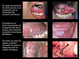 El riesgo de aparición de dicho cáncer va en progresión con la intensidad del consumo de tabaco. El alcohol es un factor favorecedor de la aparición de dicho cáncer pues fomenta la acción cancerígena del tabaco.  Por tanto, la unión de tabaco y alcohol aumenta 15 veces el riesgo de sufrir un cáncer de lengua. 