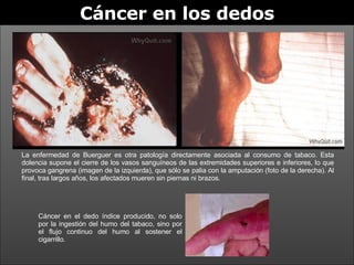 Cáncer en los dedos La enfermedad de Buerguer es otra patología directamente asociada al consumo de tabaco. Esta dolencia supone el cierre de los vasos sanguíneos de las extremidades superiores e inferiores, lo que provoca gangrena (imagen de la izquierda), que sólo se palia con la amputación (foto de la derecha). Al final, tras largos años, los afectados mueren sin piernas ni brazos. Cáncer en el dedo índice producido, no solo por la ingestión del humo del tabaco, sino por el flujo continuo del humo al sostener el cigarrillo. 