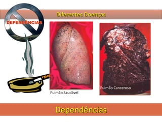 Diferentes Doenças
Dependências
DEPENDÊNCIAS
Pulmão Canceroso
Pulmão Saudável
 