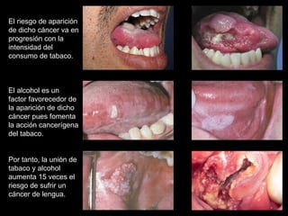 El riesgo de aparición de dicho cáncer va en progresión con la intensidad del consumo de tabaco. El alcohol es un factor favorecedor de la aparición de dicho cáncer pues fomenta la acción cancerígena del tabaco.  Por tanto, la unión de tabaco y alcohol aumenta 15 veces el riesgo de sufrir un cáncer de lengua. 