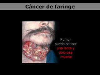 Cáncer de faringe 