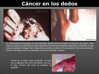 Cáncer en los dedos La enfermedad de Buerguer es otra patología directamente asociada al consumo de tabaco. Esta dolencia supone el cierre de los vasos sanguíneos de las extremidades superiores e inferiores, lo que provoca gangrena (imagen de la izquierda), que sólo se palia con la amputación (foto de la derecha). Al final, tras largos años, los afectados mueren sin piernas ni brazos. Cáncer en el dedo índice producido, no solo por la ingestión del humo del tabaco, sino por el flujo continuo del humo al sostener el cigarrillo. 