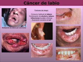 Cáncer   de   labio Factores de riesgo: Consumo habitual de  tabaco Combinación de  alcohol y tabaco Infecciones  bucales crónicas Exposición excesiva al  sol Extirpación de labios por carcinoma 