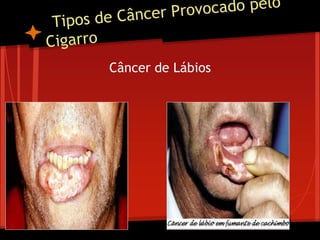 Câncer de Lábios
 