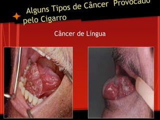 Câncer de Língua
 
