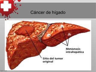 Cáncer de hígado
 