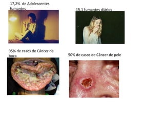 17,2%  de Adolescentes fumantes 15,1 fumantes diários 95% de casos de Câncer de boca 50% de casos de Câncer de pele 